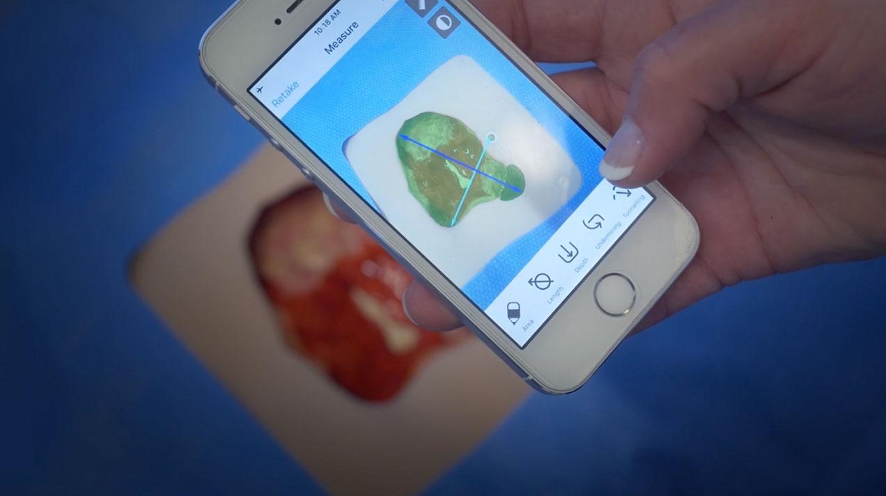 Close up of a hand holding a smartphone which has PointClickCare's Skin & Wound app open